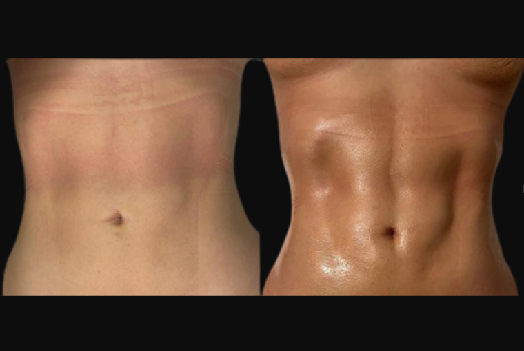 a patient with a stomach makeover results